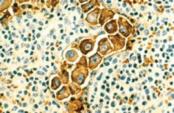 Image: Metastasized human breast cancer cells (magnified 400 times, stained brown) in lymph nodes (Photo courtesy of the [US] National Cancer Institute).